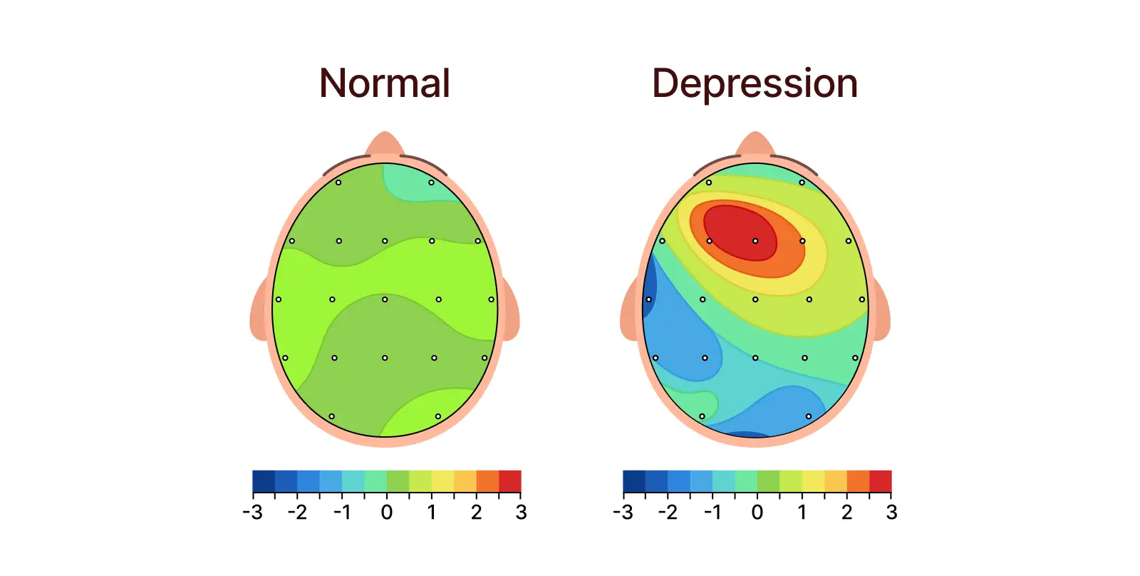 Symptoms like low motivation, emotional heaviness, or loss of interest are often linked to reduced activity in areas responsible for drive and regulation, along with increased activity in emotional processing centers