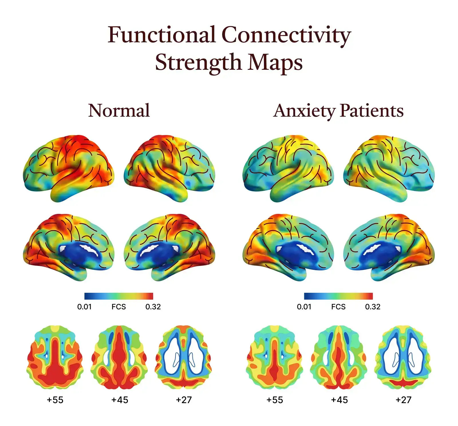 Research suggests that anxiety is not just about over or under activity in one area, but how different brain networks coordinate attention, emotion, and stress response