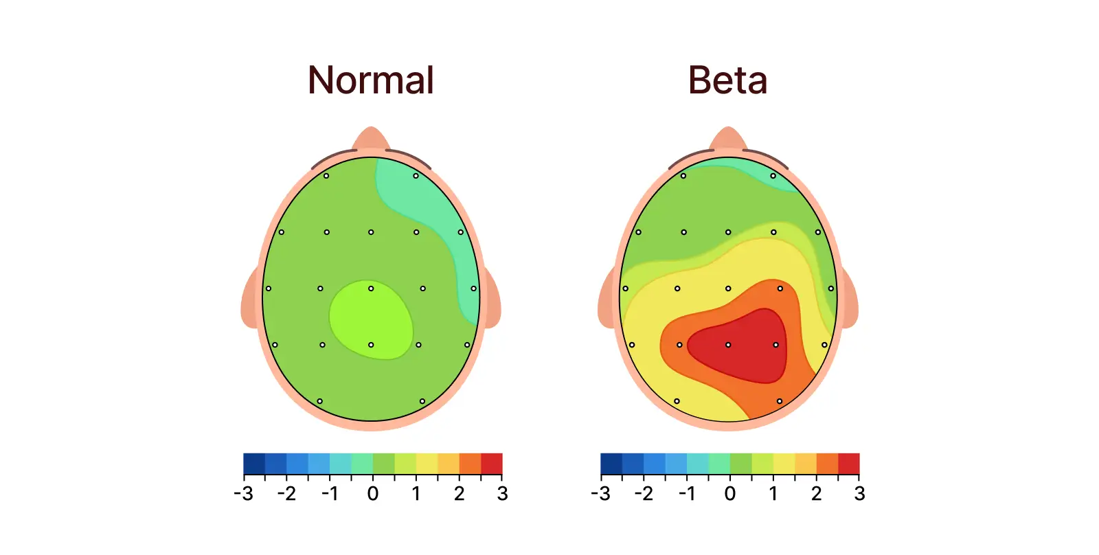 Fast beta activity is often associated with hyperarousal, excessive vigilance, and a brain that has trouble slowing down